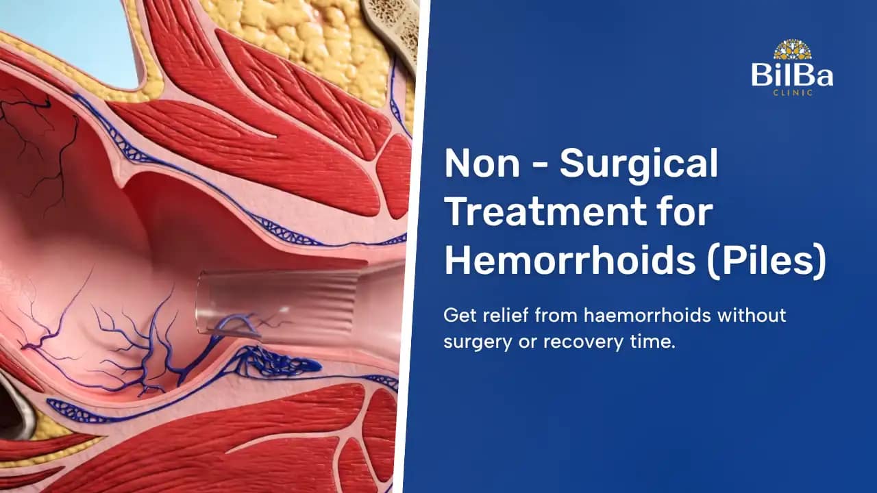 Non - Surgical Treatment for Hemorrhoids (Piles)