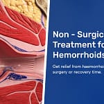Non - Surgical Treatment for Hemorrhoids (Piles)